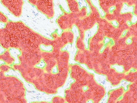 Breast HER2 AI tumor heatmap markup