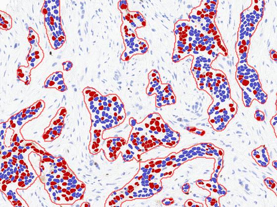 Breast Ki67 AI markup 