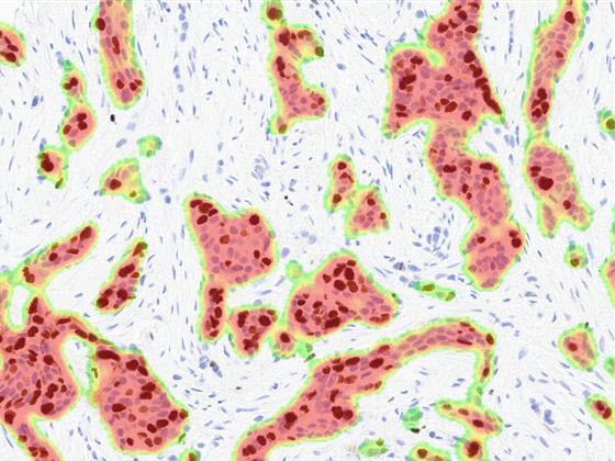 Breast Ki67 AI tumor heatmap markup
