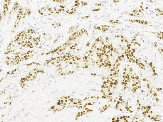 PR IHC-stained breast cancer 