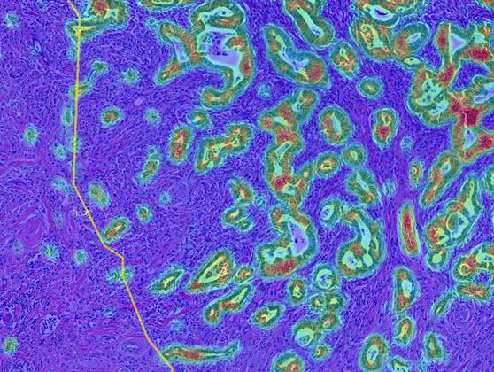 CRC Macrodissect AI tumor heatmap, zoomed in