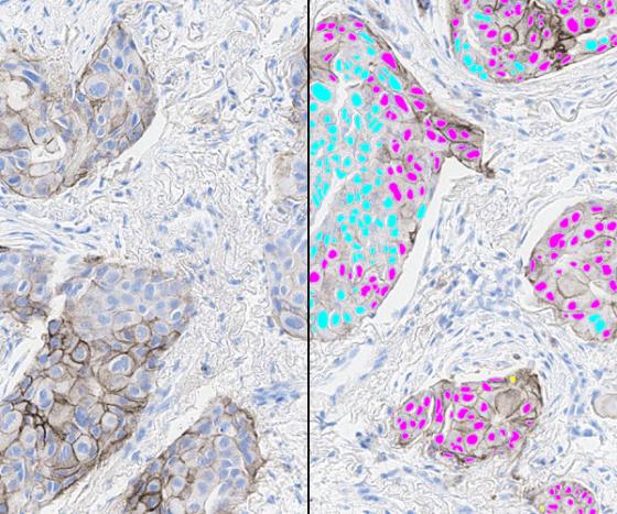 featured-image-lung-pd-l1_Split_600x500