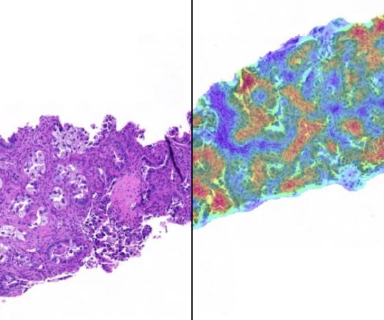 H&E digital slide (left) with Lung Macrodissection AI markup (right) displaying the tumor cell density heatmap. 