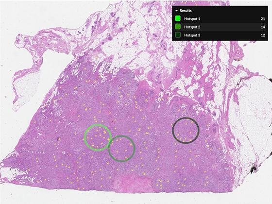 Step 1: Mitotic Figure Detection & Hotspot Identification