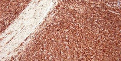 Example of an immunohistochemistry IHC stain of a tonsil sample. The sample was stained for kappa light chain and shows a heavy background stain due to ineffective protein block.