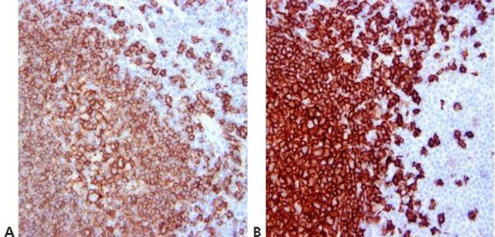 Example of an immunohistochemistry IHC stain where sections from the same tonsil specimen have been stained using different detection systems.