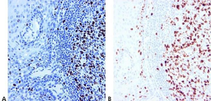 Example of immunohistochemistry IHC stain of a tonsil specimen. Different levels of hematoxylin counterstaining are shown in tonsil stained for Ki67.
