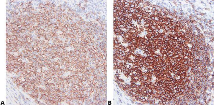 Example of immunohistochemistry stain. These sections of human tonsil from the same block have been stained with the B cell marker CD20 using primary monoclonal antibodies from different sources (suppliers). In each case, the recommended pretreatment and optimized dilution were used. There is an obvious difference in the quality of the results achieved.