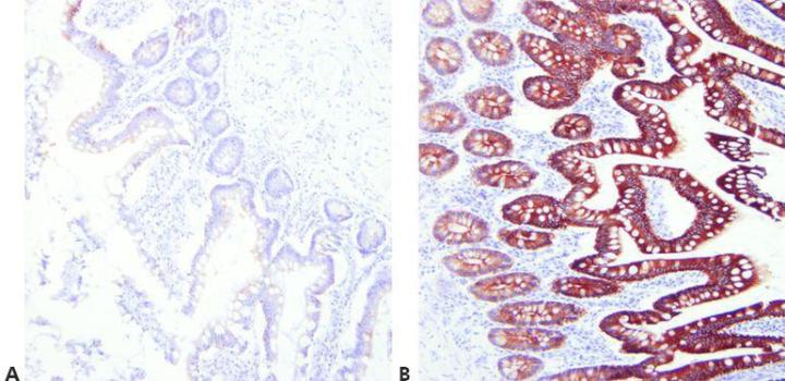 Example of immunohistochemistry IHC stain of intestine secine stained for cytokeratin AE1/AE3. Weak staining is compared to strong, precise staining.