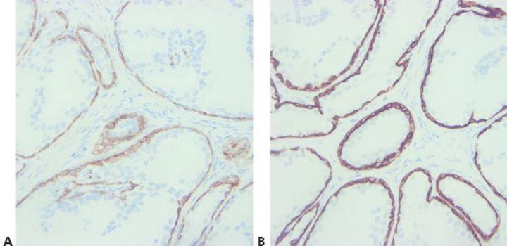 Example of immunohistochemistry IHC stain of prostate sample. Weak versus strong stains for cytokeratin 34βE12 are shown.