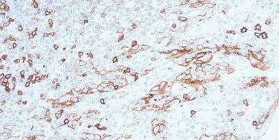 Example of an immunohistochemistry IHC stain of a tonsil sample. The base of a tonsillar crypt stained for CD5 is illustrated.