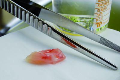 This fresh specimen has just been removed from a patient during surgery. Because it is resting on an absorbent surface and the theater is quite warm it will rapidly dry out unless it is immediately placed in fixative.