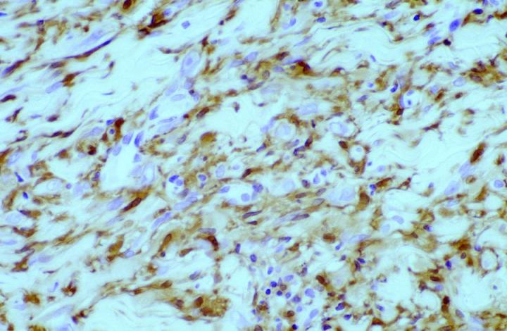 Higher power demonstrating predominantly cytoplasmic labelling of tumor cells. Magnification at X100.