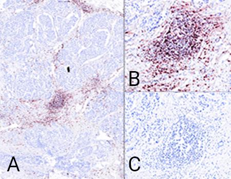 CD8-MHC-I-interaction-in-breast-cancer-NaveniBright-BOND-RX-HRP-450x340