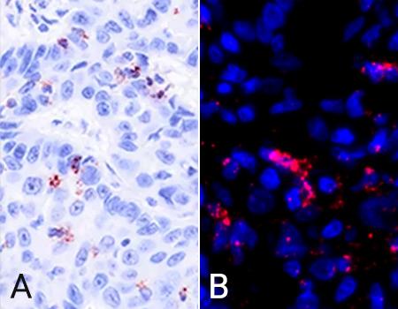 PD1-PD-L1-interaction-in-head-neck-cancer-Naveni-PD1PD-L1-BOND-RX-HRP-450x340-1
