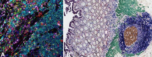 Figure 3. A and B images show Leica Biosystems spatial fluorescent multiplex IHC and chromogenic multiplex IHC representation from breast cancer and colon tissue, respectively.