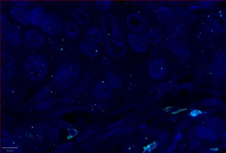 POLR2A Positive Control Multiomic Staining in Breast Cancer
