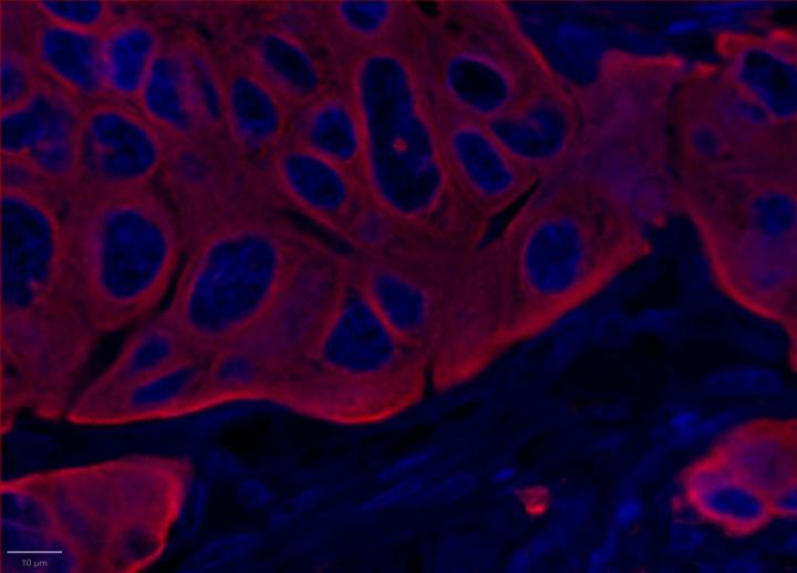 PanCK Positive Control Multiomic Staining in Breast Cancer