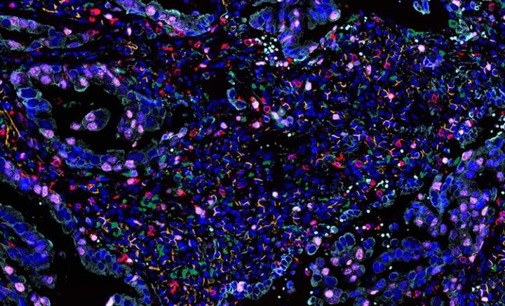 Lung-Cancer-Tissue-20x-APO-7-color_006-750x454