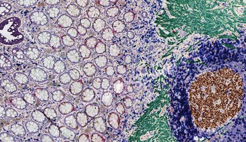 Multiplex Staining 5-Plex