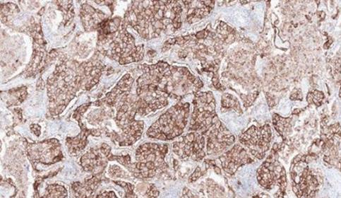 Lung-PD-L1-CAL10-RUO-1000x385