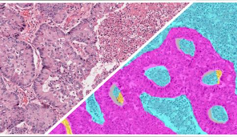 HALO-AI-NSCLC-H&E-Tumor-Tissue-Detection