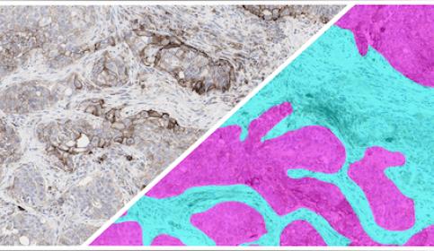 HALO-AI-NSCLC-IHC-Tumor-Tissue-Detection
