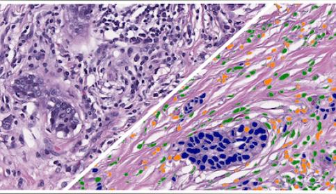 HALO-AI-Pan-Cancer-H&E-Lymphocyte-Cell-Phenotyper