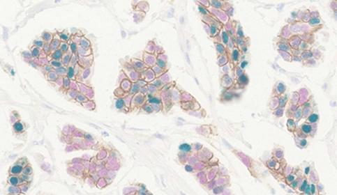 Chromogenic Stain of Breast Tissue with ChromoPlex III and BOND RX